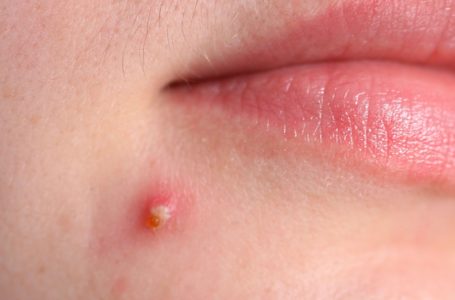 Muka Berjerawat Kerana Sedang Dilamun Cinta. Boleh Percaya Ke?